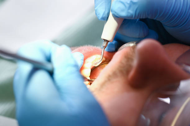 Best Emergency Wisdom Teeth Removal in Hodgkins, IL