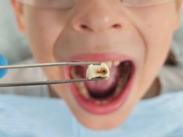 Best Emergency Dental Care for Broken or Chipped Teeth in Hodgkins, IL